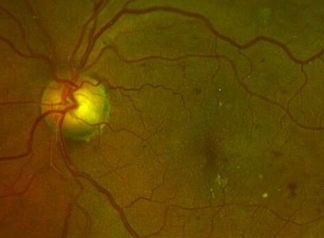 Retina  & Uvea for Residents