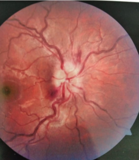 Squint and Neuro-ophthalmology