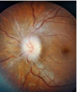 Neuro-ophthalmology Q Bank