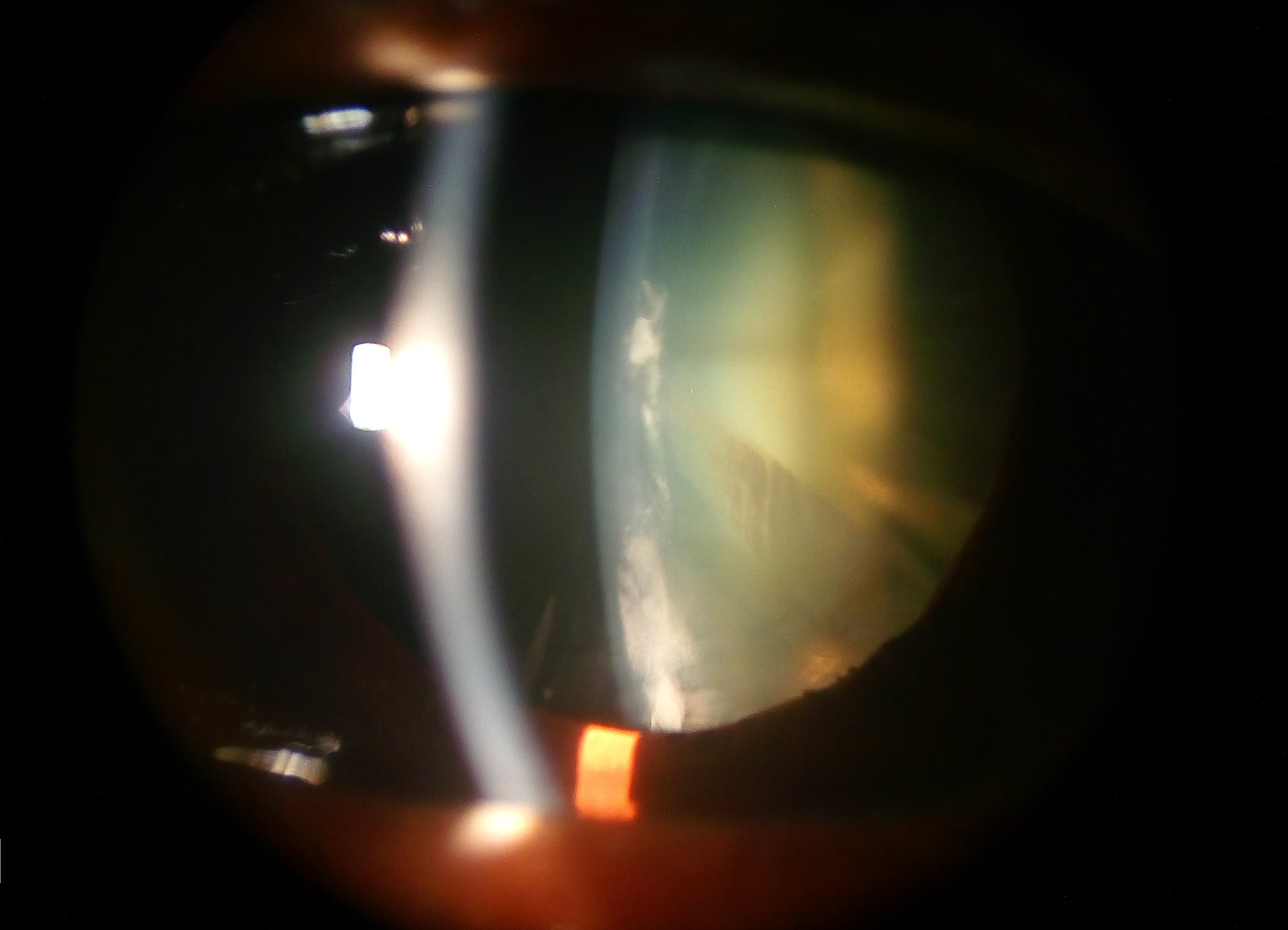 Lens and Cataract - Test Series
