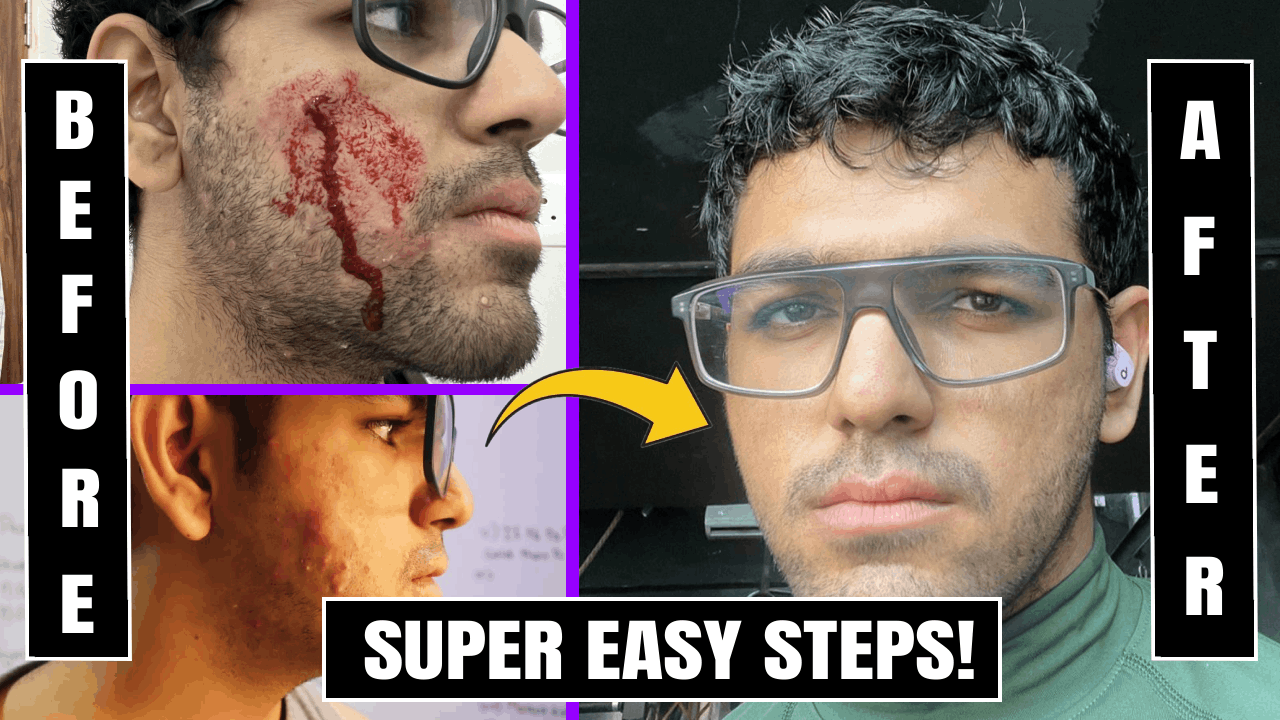 No more Acnes: Get a glowing skin naturally!