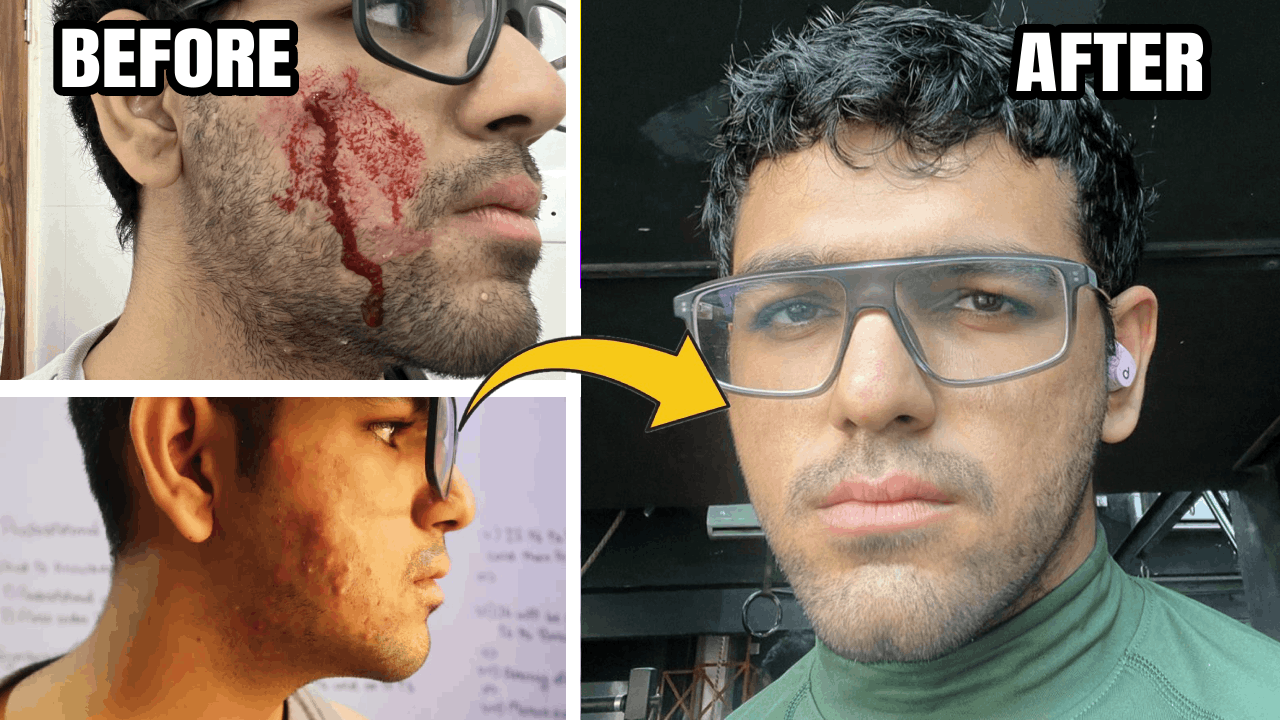 No more Acnes: Get a glowing skin naturally!