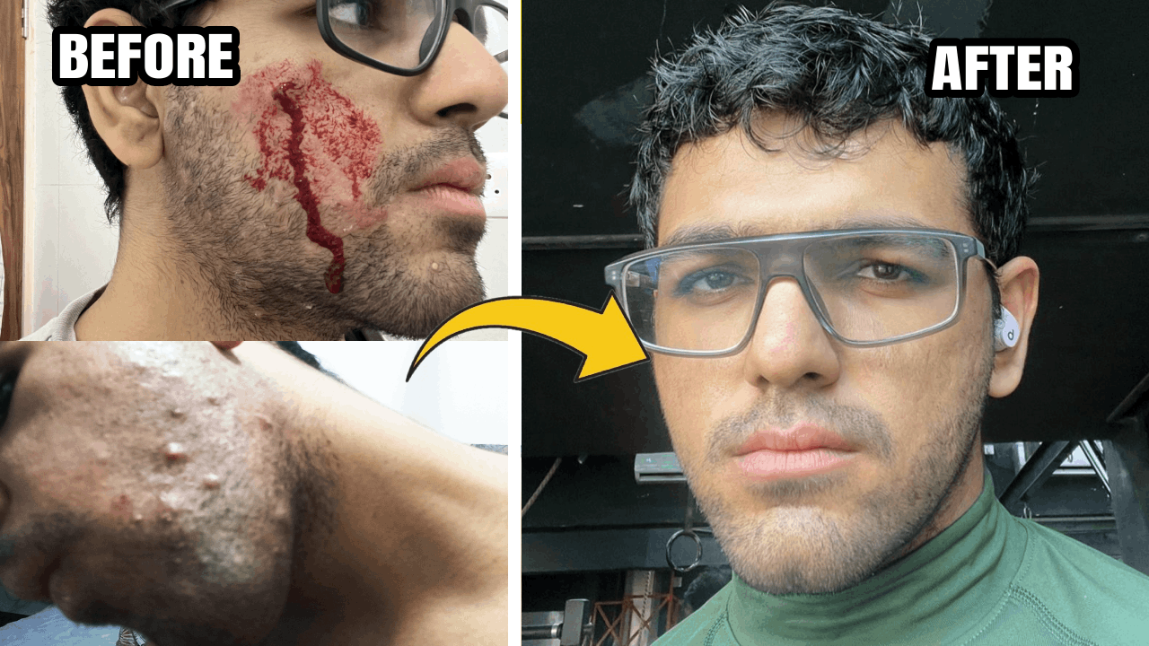 No more Acnes: Get a glowing skin naturally!