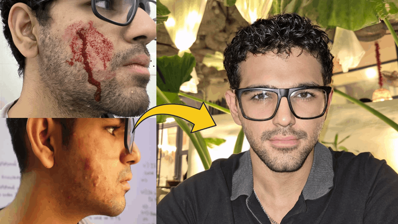 No more Acnes: Get a glowing skin naturally!