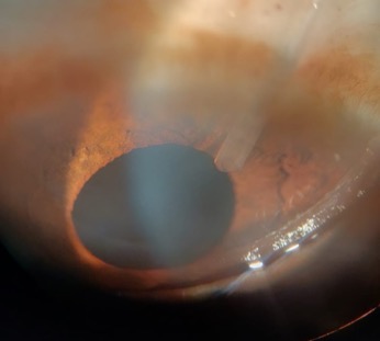 Glaucoma Test Series